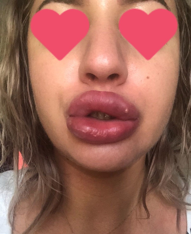 Augmentarea buzelor cu acid hialuronic – tot ce trebuie sa stiti!