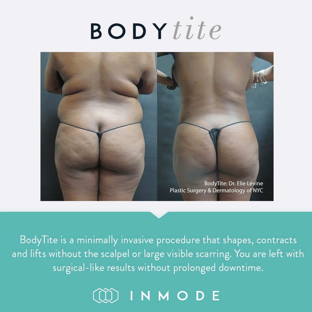 bodytite-constanta-dr-dali-liposuctie-10 Proceduri BodyTite