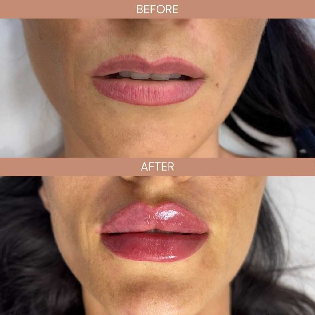 Cât costă injectarea cu acid hialuronic în București? Ghid complet despre prețuri, diferențe și ce plătești de fapt acid-hialuronic-buze-drdali