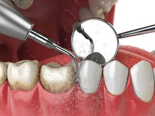 detrartraj-dentar.jpg Stomatologie